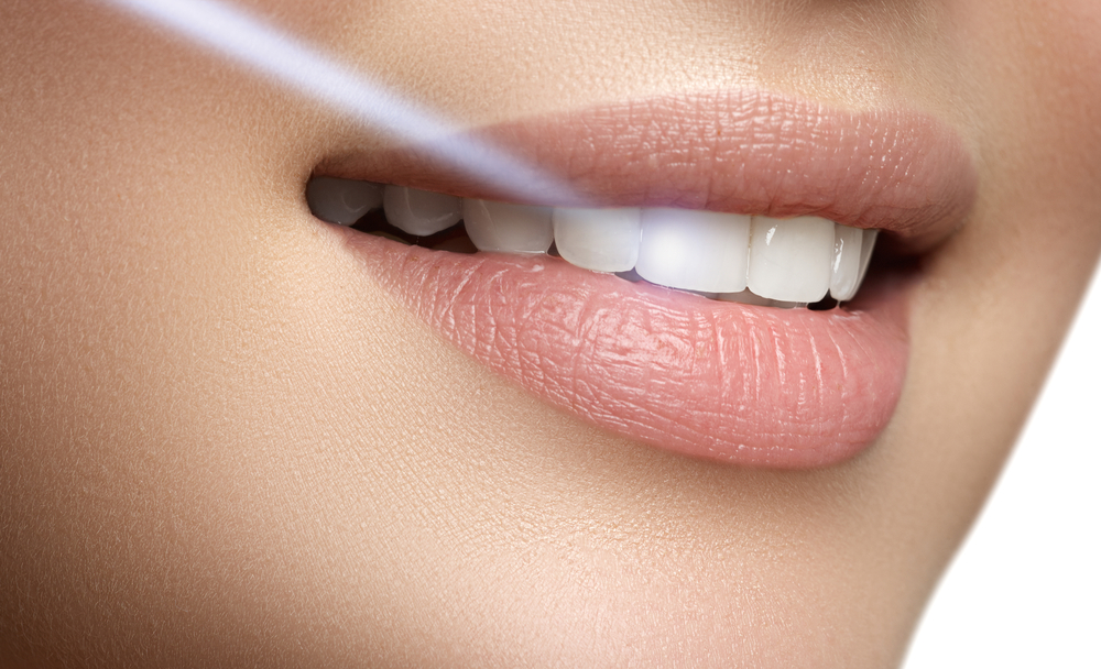 Laser teeth whitening Chennai