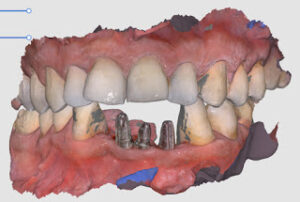 teeth replacement with implants