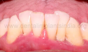 teeth replacement with dental implanst in chennai