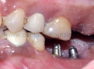 laser gum treatment in chennai