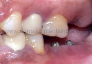 laser crown lengthening