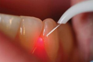 laser gum treatment