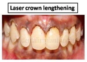 laser crown lengthening 