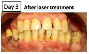 laser gum treatment in chennai