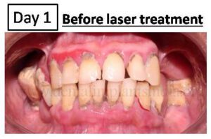laser gum treatment in chennai